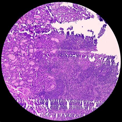 Thyroid Cancer Microscopic Image Of Metastatic Papillary Carcinoma Of