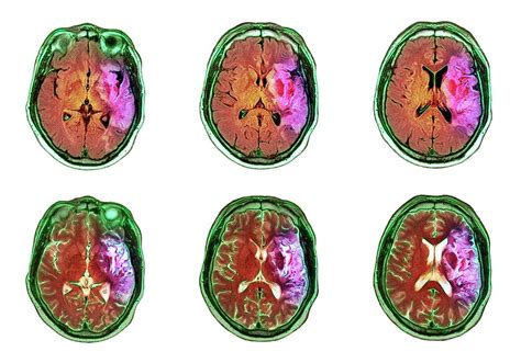 Stroke Photograph By Simon Fraser Newcastle Hospitals Nhs Trust Science