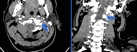 Ct Neck Angiography For The Upper Cervical Spine The Left Vertebral