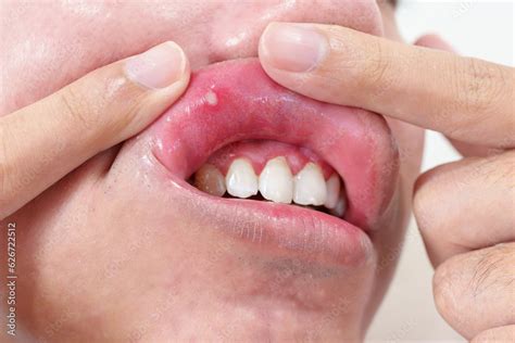 Mouth Ulcer Sore Or Aphthous Stomatitis Oral Health And Medical