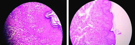 Pigmented purpuric dermatosis-like lesions (H & E; ×100 & ×400 ...