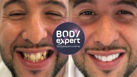 Couronnes Dentaire Avant Apr S R Sultats Apr S La Pose Body Expert