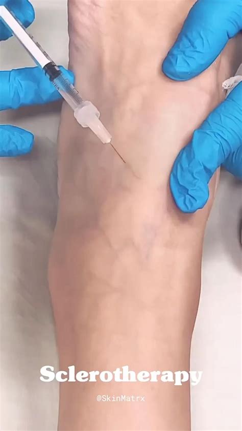 Sclerotherapy For Spider Veins Skin Matrx Burbank Ca Medspa Cosmetics