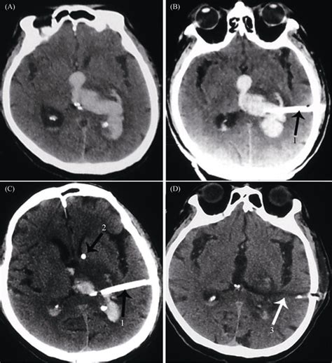 The CT scan of thalamic hemorrhage before and after THD. (A):... | Download Scientific Diagram