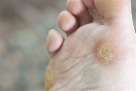 Understanding Warts: Causes, Types, and Prevention Tips | by Jones ...