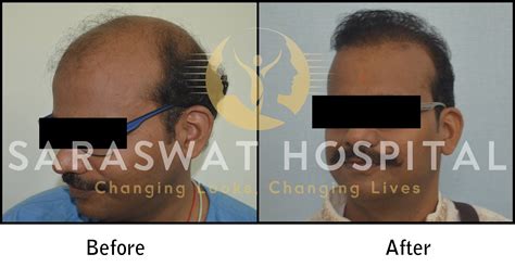 Hair Transplantation Before And After Results Saraswat Hospital