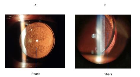 A Review Of Posterior Capsular Opacification Published In Cro