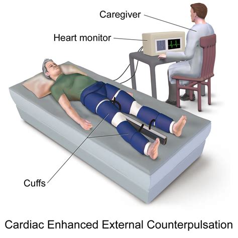 心臟病 體外反搏治療 Eecp Therapy ★ 優活 健康網 ★ Living Well Website