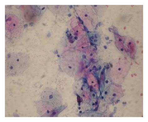 Pap Smear Test Of The Cervicovaginal Smears Showing Different Stages Of