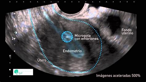 La implantación Fecundación In Vitro FIV Reproducción asistida