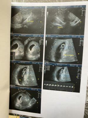 Hematoma Subcori Nico Babycenter