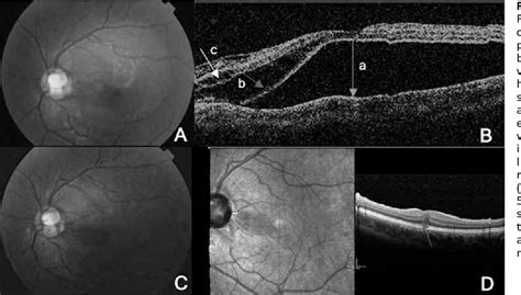 Figure 1 From Vitrectomy Without Laser Treatment For Macular Serous