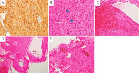 Glial Fibrillary Acidic Protein GFAP A And Hematoxylin And Eosin