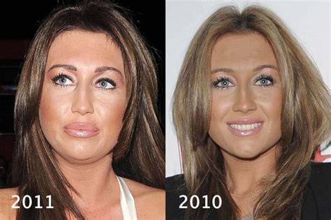 Lauren Goodger Plastic Surgery £6k 34e Breast Implants Nose Job And