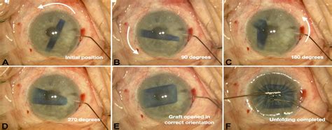 “the Spinning Technique” For Unfolding Tightly Scrolled Dmek Cornea