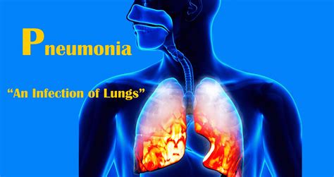 Pneumonia Causes Signs Symptoms Shot And Pneumonia Treatment