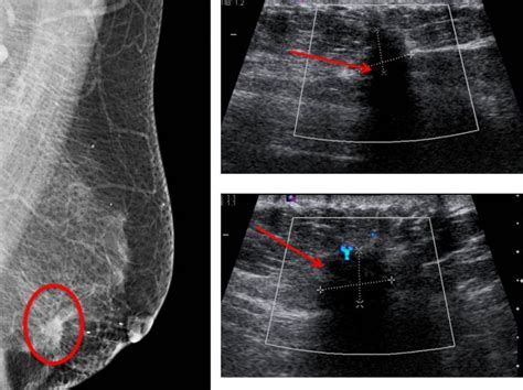 Ductal Carcinoma In Situ Radiology Cases