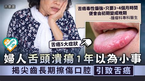 不容忽視︳婦人舌頭潰瘍1年以為小事 揭尖齒長期擦傷口腔引致舌癌︳附舌癌5大症狀 晴報 健康 腫瘤及癌症 D211017