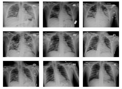 Chest Radiographs The Radiographs Show Bilateral Ground Glass