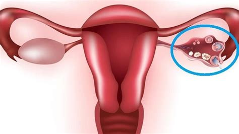 Ovarian Cysts Symptoms And Causes Best Gynecologist In Delhi