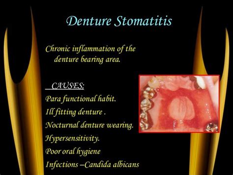 Histology Of Alveolar Bone Alveolar Mucosa And Its Prosthodontic Cons