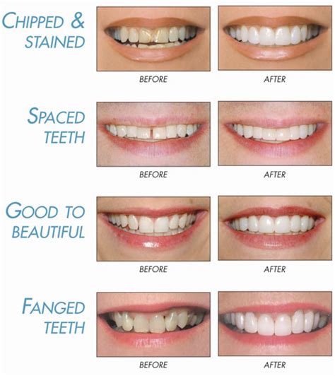 Lumineers Vs Veneers Before After