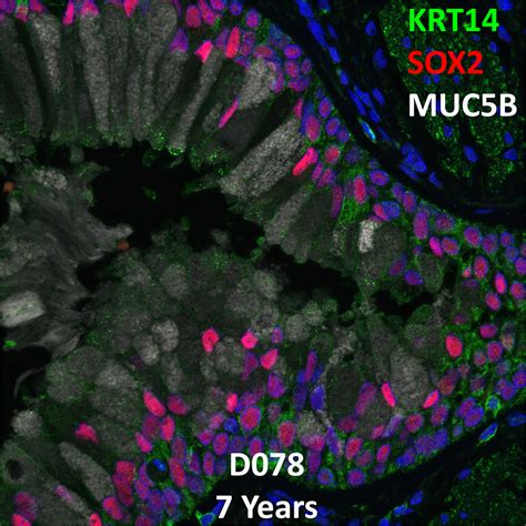 Year Old Human Lung With Asthma Immunofluorescence And Confocal