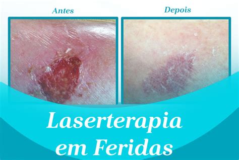 Laserterapia Em Feridas Consultorio Reabilitese2 Reabilite