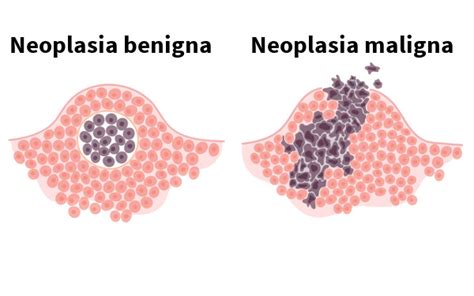 Discusi N Que Es Neoplasia Lipomatosa Benigna Viral Estudiar