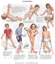 Floppy Baby Syndrome Causes Symptoms And Treatments Artofit