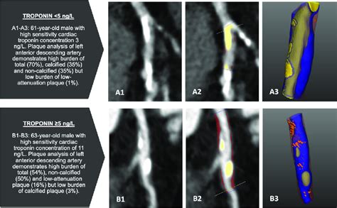 Comparative Cases Of Plaque Burden In Patients With Troponin