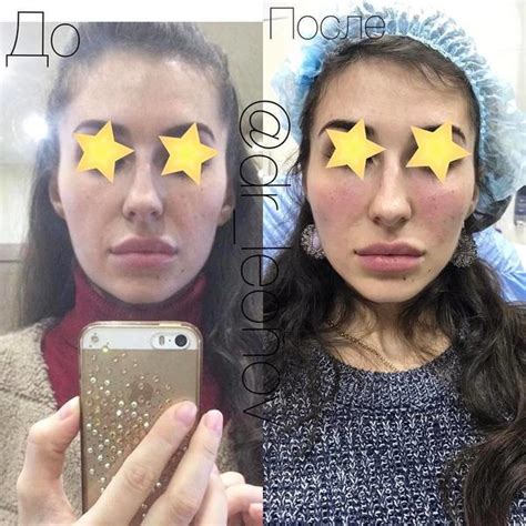 Botox Before And After Pictures (1) » Facelift: Info, Prices, Photos, Reviews, Q&A