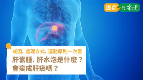 肝水泡是什麼？會變成肝癌嗎？肝囊腫成因、處理方式、運動原則一次看 癌症問康健