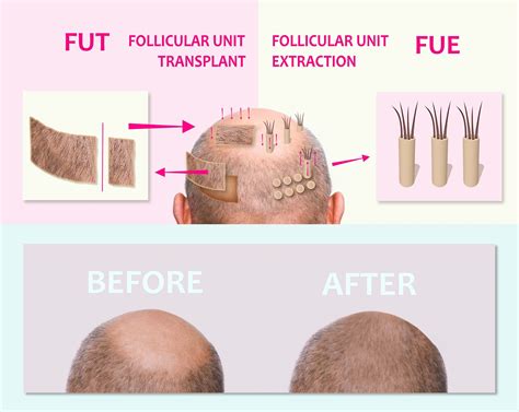 Fut Vs Fue Hair Transplants Which Is Better Aventus Clinic