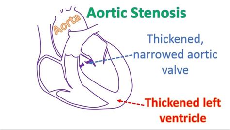 What Is Aortic Stenosis All About Heart And Blood Vessels