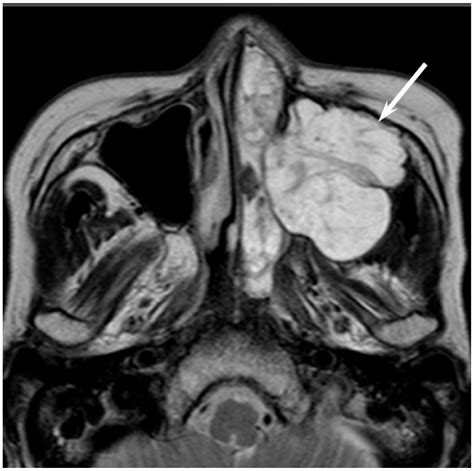 Jcm Free Full Text Imaging Characteristics Of Malignant Sinonasal