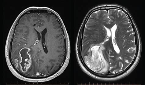 RACGP Current Management Of Cerebral Gliomas