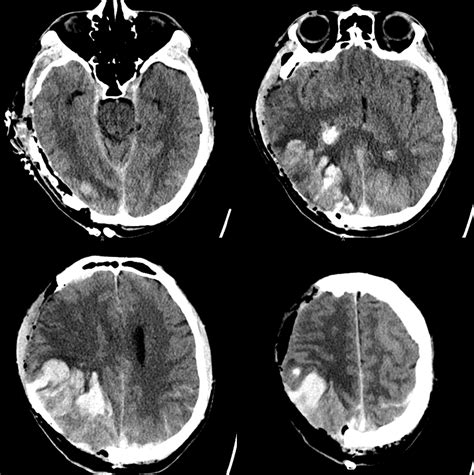 Venous Sinuses