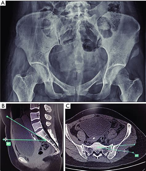 Preoperative X Ray Of A Patient Who Sustained Left Sij Dislocation A Download Scientific