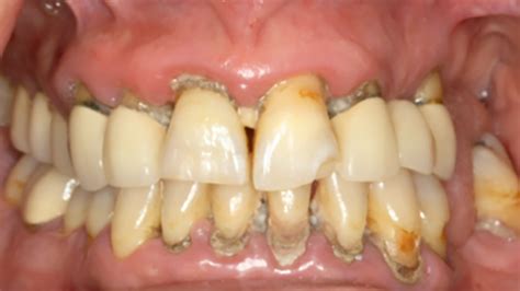 Diagn Stico Y Tratamiento De La Periodontitis Estadio Iv De Acuerdo Con