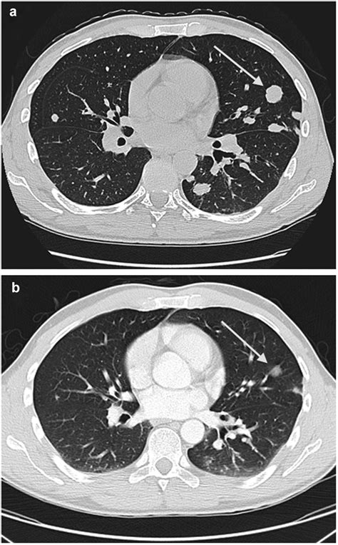 A Ct Demonstrating Pulmonary Metastases Arrow Delineates A Pulmonary