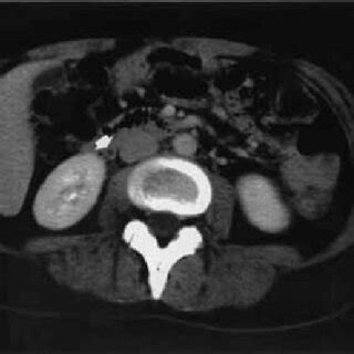 Abdominal Computed Tomography CT After 1 Month Abdominal CT Showed