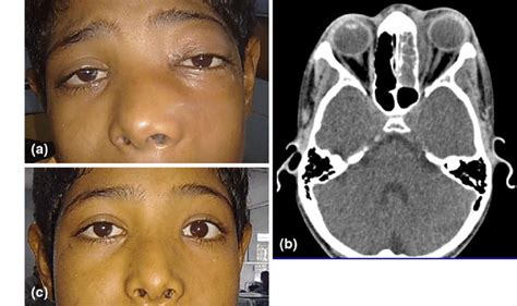 A Clinical Photograph Showing Proptosis With Periorbital And Facial