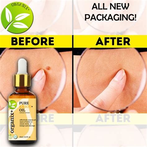 ORGANIX Pure Organic Kasoy Oil For Warts Skin Tags Skin Growth Mole