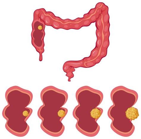 Colon and cancer process 295715 Vector Art at Vecteezy