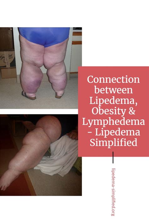 Connection Between Lipedema Obesity Amp Lymphedema Lipedema Simplified