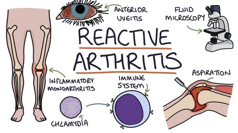 Reactive Arthritis Cause Symptoms Diagnosis Treatment