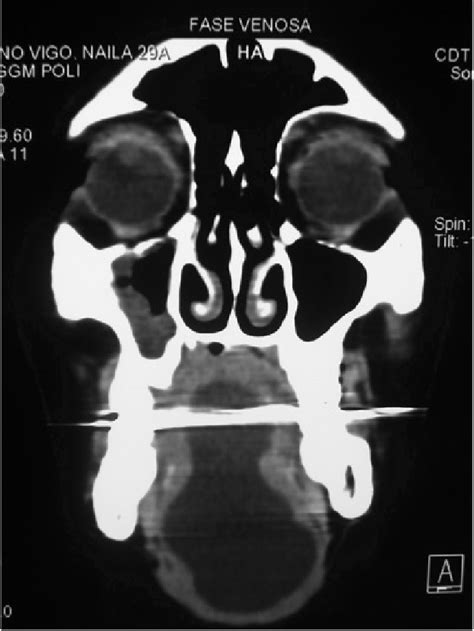 Figure 1 From Quiste Epidermoide Gigante En Reloj De Arena Del Piso De