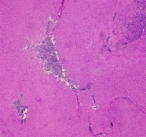 Thyroid Cancer Microscopic Image Of Follicular Neoplasm Malignant