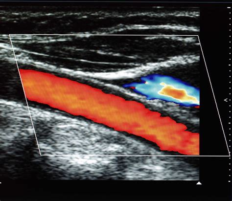 Doppler Sonographie